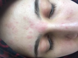 Watsons Revolution Alerji Acillll