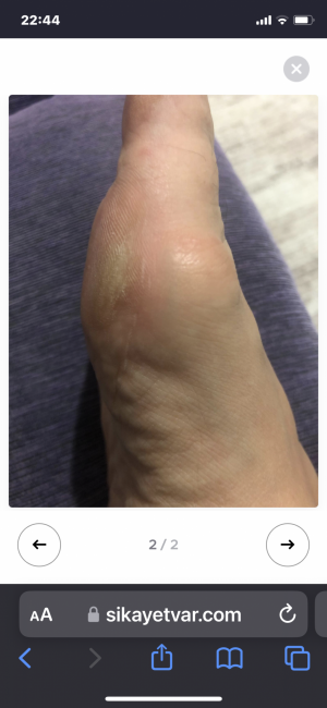 Skechers Ayağımda Nasır Oluştu