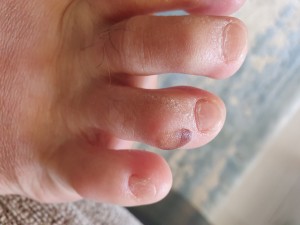 Skechers Ayakkabı Yara Yaptı