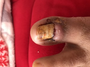 Medical Park Antalya Başarısız Batık Tırnak Ameliyatı