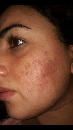 Lilium Güzellik Merkezi Bb Glow Ve Cilt Bakımı Yaptırdım Ama Hiçbir Faydasını Görmedim