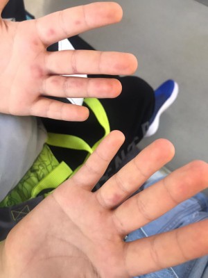 Media Markt Dezenfektan Kullanımı Yeğenimin Elini Yaktı