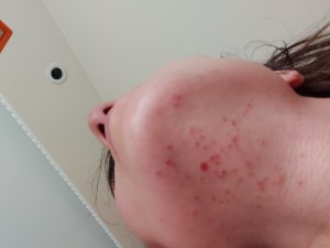 Ice Therapy Yaradan Çok Zararı Olan Ürün. Hiçbir Etkisi Yok. Cildi Tahriş Edip Yakıyor.