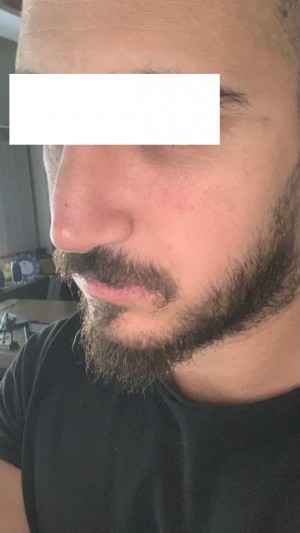 Opr. Dr. Mustafa Ali Yanık Rinoplasti Mağduriyeti