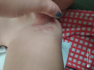 Molfix Pişik Yapan Ve Patlayan Bez !