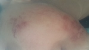 Şok Market Ten Marka Sir Ağdası Aldım Uyguladıktan 5-6 Saat Sonra Yüzümde Feci Yanıklar Oluştu Şikayetçiyim