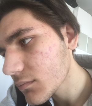 Bioderma Yüz Temizleme Jeli Yüzümü Mahvetti